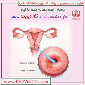 درمان زخم دهانه رحم با لیزر
